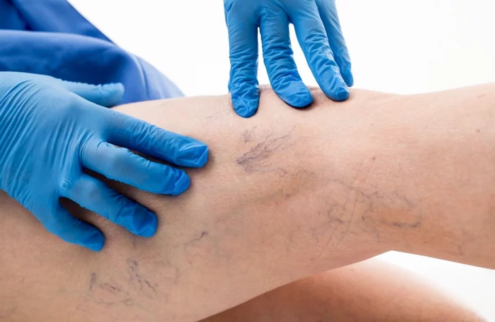 Avenia Clinic — специализированный центр лечения варикоза в Алматы